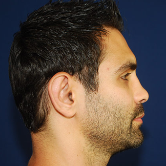 Ear Surgery after 1439499