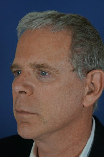 60 year male with liquid facelift 923514