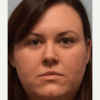 25-34 year old woman treated with Rhinoplasty before 3703439