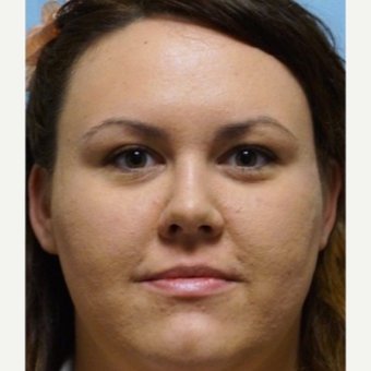 25-34 year old woman treated with Rhinoplasty after 3703439