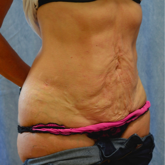 45-54 year old woman treated with Tummy Tuck before 3214104
