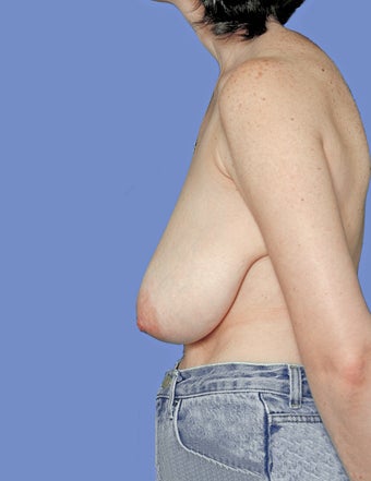 45-54 year old woman treated with Breast Reduction 2447854