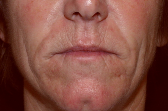 55 year old woman treated for deep wrinkles around her mouth with surgical dermabrasion. before 1219987