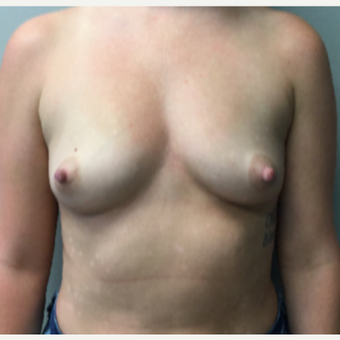 28 year old woman treated with Breast Augmentation before 3294692