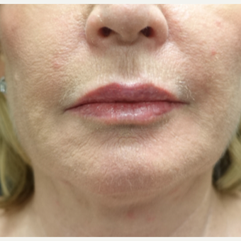 55-64 year old woman treated with Fat Transfer for her Lip Augmentation after 3130000