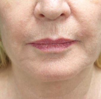 55-64 year old woman treated with Fat Transfer for her Lip Augmentation before 3130000