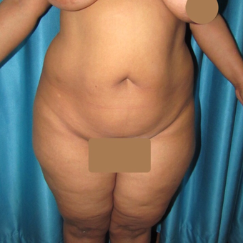 35-44 year old woman treated with Liposuction before 3221780