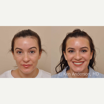 30 year old woman treated with Hair Transplant before 3009535