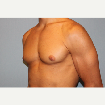 25-34 year old man treated with Male Breast Reduction before 3565065