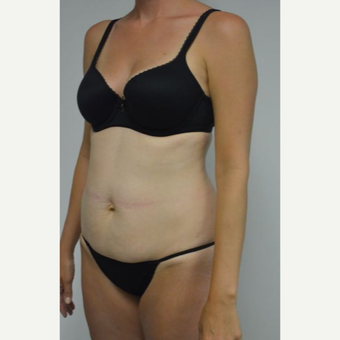 35-44 year old woman treated with Tummy Tuck and liposuction of her flanks and lower back before 3459014