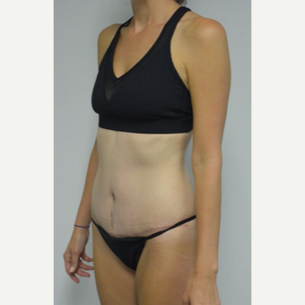 35-44 year old woman treated with Tummy Tuck and liposuction of her flanks and lower back after 3459014