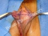 Labial Reduction before 677461