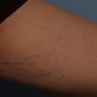 18-24 year old woman treated with Stretch Marks Treatment with ICON Frax 1540 laser before 3224901