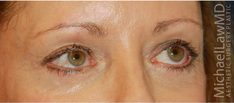 Eye Bag Surgery 892146
