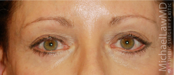 Eye Bag Surgery after 892146