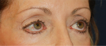 Eye Bag Surgery 892146