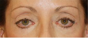 Eye Bag Surgery before 892146