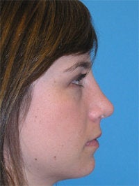 Septorhinoplasty: Before and After after 52479