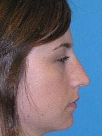 Septorhinoplasty: Before and After before 52479