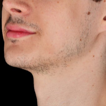 18-24 year old man treated with Lip Augmentation after 3220484
