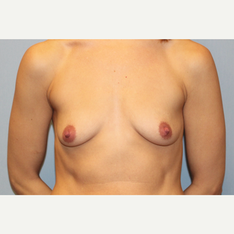 25-34 year old woman treated with Breast Augmentation before 3569615
