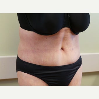 Body Lift after massive weight loss preop BMI 26 after 2589144