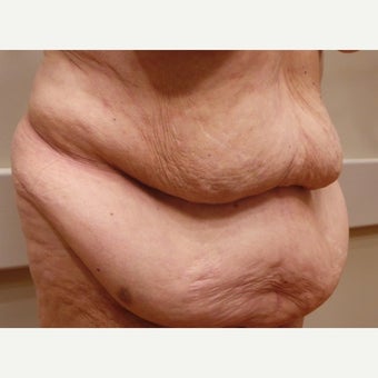 Body Lift after massive weight loss preop BMI 26 before 2589144