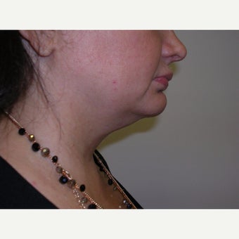 35-44 year old woman treated with Kybella before 2303327