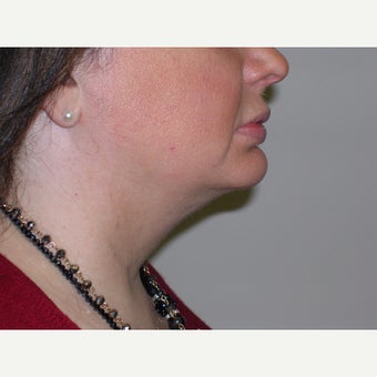 35-44 year old woman treated with Kybella after 2303327