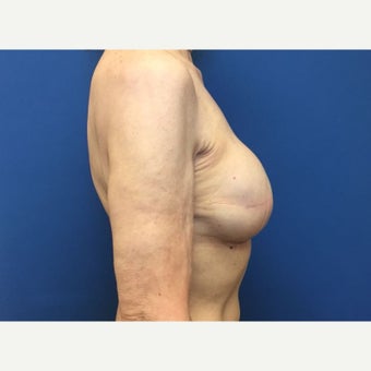 55-64 year old woman treated with Breast Reconstruction 1818379