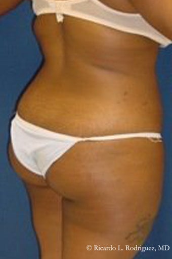 Brazilian Butt Lift before 101291