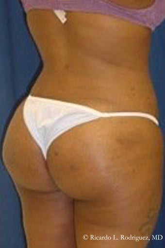 Brazilian Butt Lift after 101291