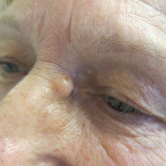 62 year old woman treated with Cyst Removal from beside eye before 3841628