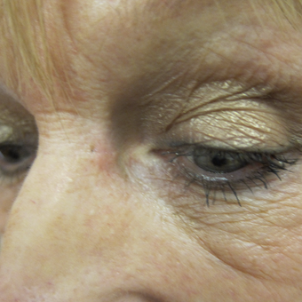 62 year old woman treated with Cyst Removal from beside eye after 3841628