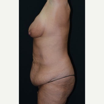 45-54 year old woman treated with Mommy Makeover 1550998