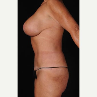 45-54 year old woman treated with Mommy Makeover 1550998