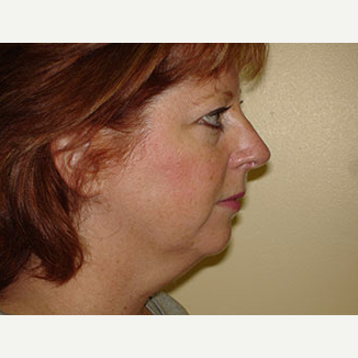 35-44 year old woman treated with Facelift, Chin implant and 4-Lid Blepharoplasty before 3266303