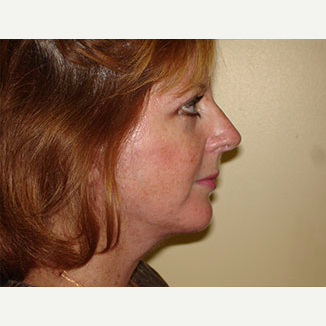 35-44 year old woman treated with Facelift, Chin implant and 4-Lid Blepharoplasty after 3266303