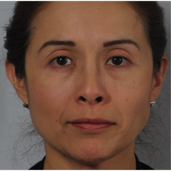 45-54 year old woman treated with Nose Surgery after 3265128