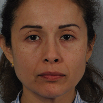 45-54 year old woman treated with Nose Surgery before 3265128