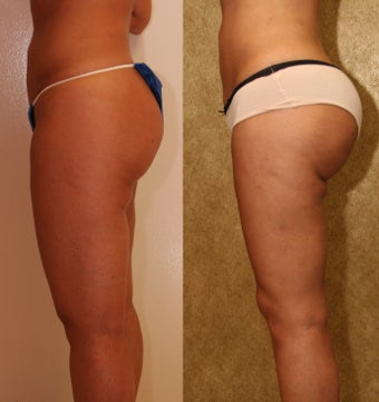 Brazilian Butt Lift Revision before 993812