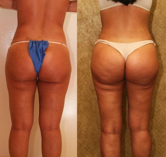 Brazilian Butt Lift Revision 993812