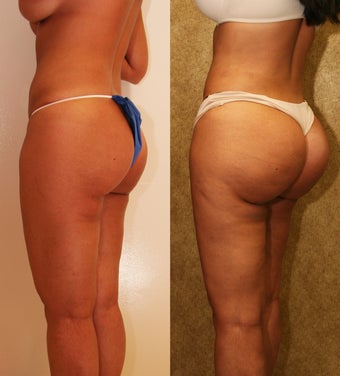 Brazilian Butt Lift Revision after 993812