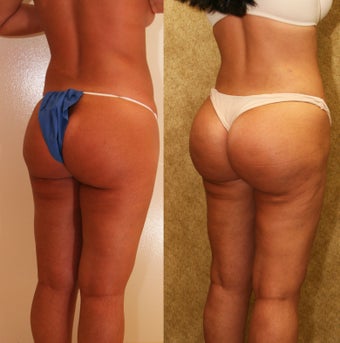 Brazilian Butt Lift Revision 993812