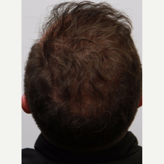 35-44 year old man treated with Organic Hair Transplant after 3172523