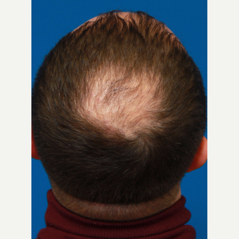 35-44 year old man treated with Organic Hair Transplant before 3172523