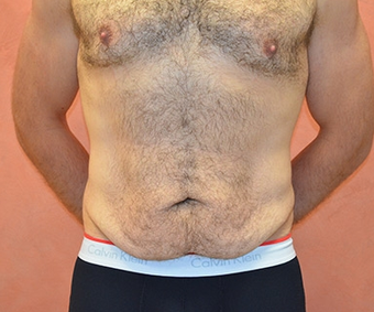Body Lift before 1451002