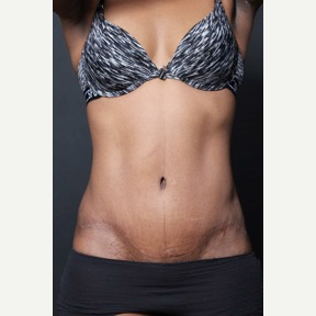 25-34 year old woman treated with Tummy Tuck after 2818974