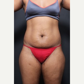 25-34 year old woman treated with Tummy Tuck before 2818974