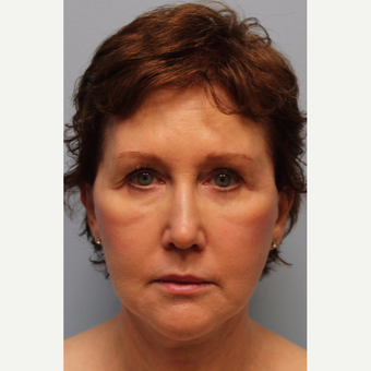 55-64 year old woman treated with Facelift, Laser resurfacing after 3615772